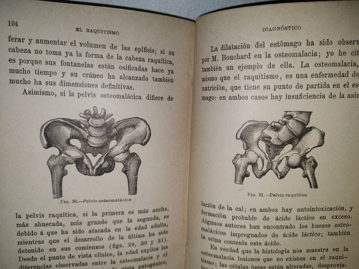 60- El Raquitismo - J. Comby - Barcelona. Espasa Y A Editores, 1895