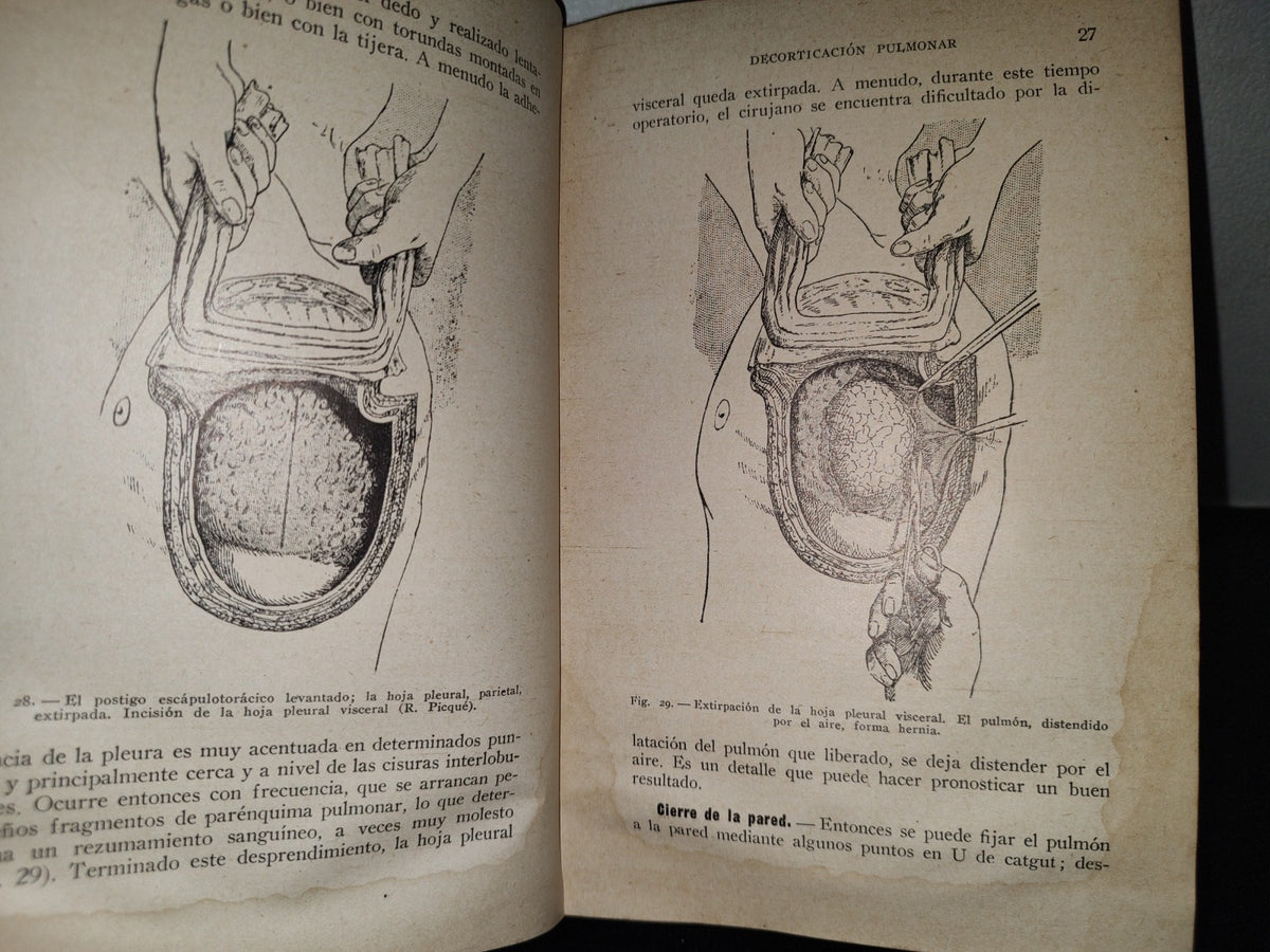 64- Cirugía Del Tórax Y Del Miembro Superior - A. Schwartz Y G. Métivet - 1933