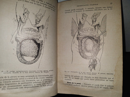 64- Cirugía Del Tórax Y Del Miembro Superior - A. Schwartz Y G. Métivet - 1933