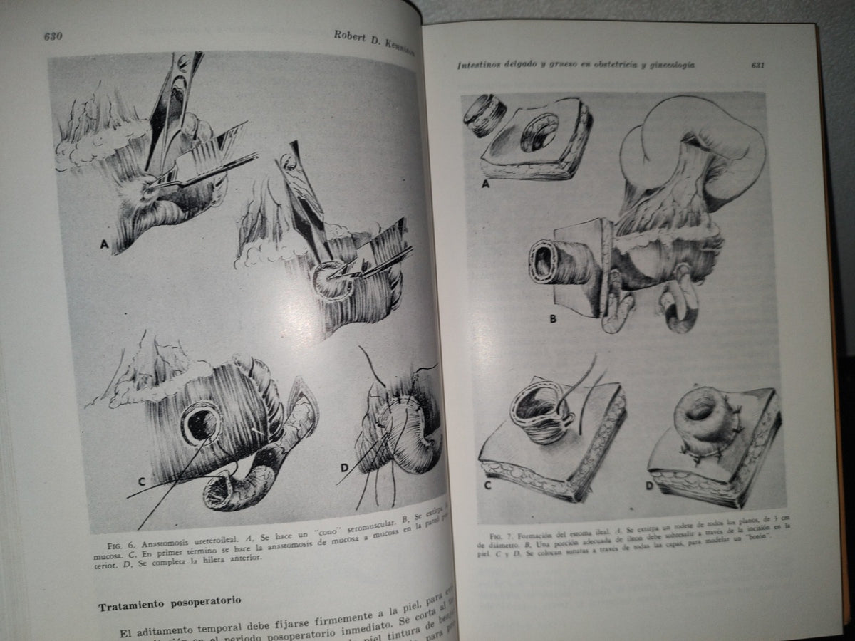 89- Clínicas Obstétricas Y Ginecológicas. El Parto Intestinal, Histrectomía Abdomnal