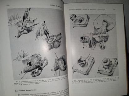 89- Clínicas Obstétricas Y Ginecológicas. El Parto Intestinal, Histrectomía Abdomnal