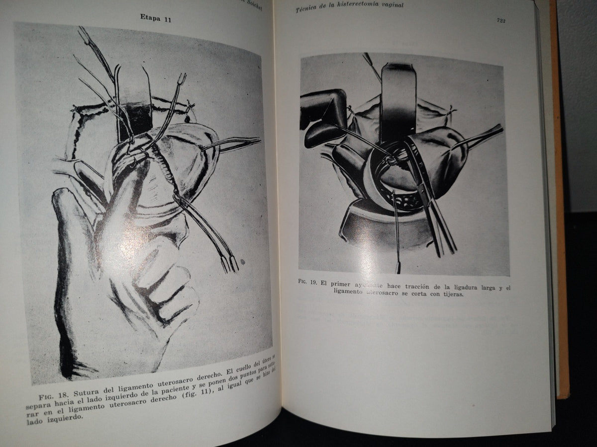 89- Clínicas Obstétricas Y Ginecológicas. El Parto Intestinal, Histrectomía Abdomnal