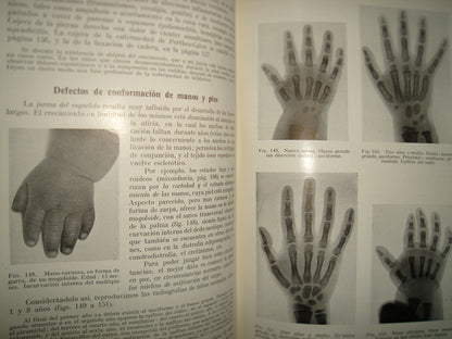 161- Diagnóstico De Las Enfermedades De Los Niños - Dr. E. Feer - Editorial Labor 1952