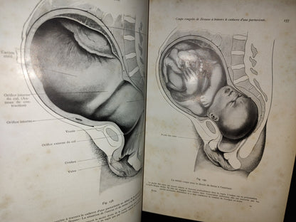 64- Francés. Compendio De Obstetricia / Précis D'Obstétrique En 28 Leçons - Ernest Bumm - 1911