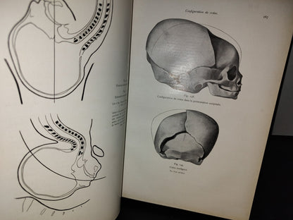 64- Francés. Compendio De Obstetricia / Précis D'Obstétrique En 28 Leçons - Ernest Bumm - 1911