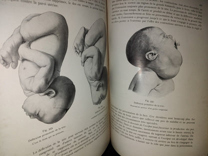 64- Francés. Compendio De Obstetricia / Précis D'Obstétrique En 28 Leçons - Ernest Bumm - 1911