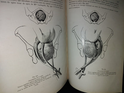 64- Francés. Compendio De Obstetricia / Précis D'Obstétrique En 28 Leçons - Ernest Bumm - 1911