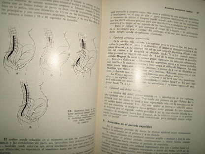 23- Clínica Ginecológica. Volumen 2, Número 2. Analgesia Y Anestesia En Obstetricia