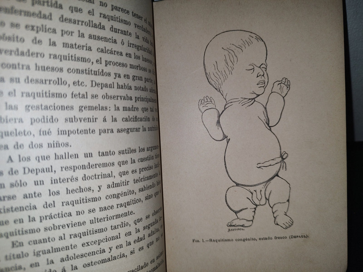 60- El Raquitismo - J. Comby - Barcelona. Espasa Y A Editores, 1895