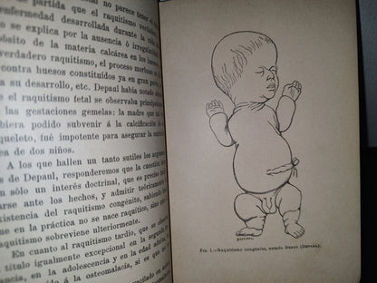 60- El Raquitismo - J. Comby - Barcelona. Espasa Y A Editores, 1895