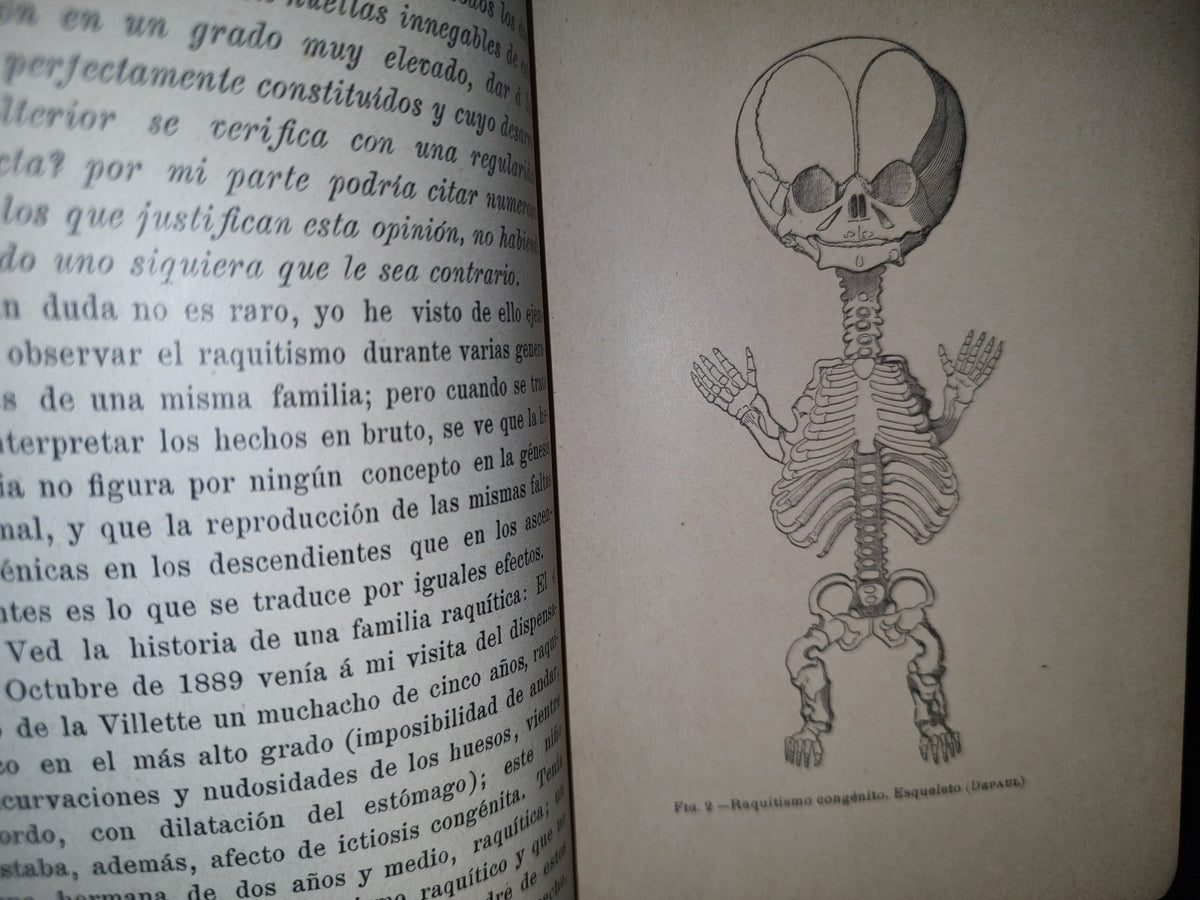 60- El Raquitismo - J. Comby - Barcelona. Espasa Y A Editores, 1895