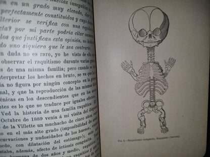 60- El Raquitismo - J. Comby - Barcelona. Espasa Y A Editores, 1895