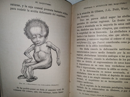 60- El Raquitismo - J. Comby - Barcelona. Espasa Y A Editores, 1895