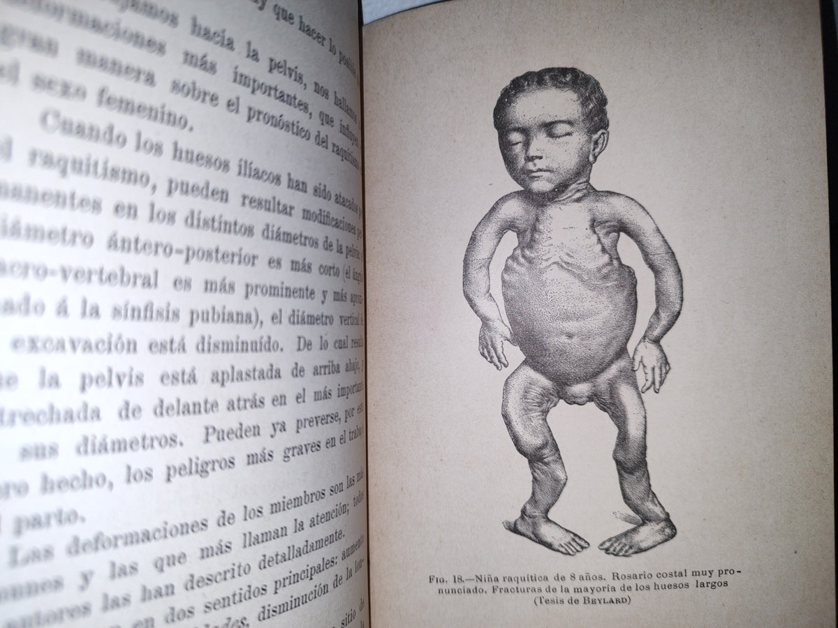 60- El Raquitismo - J. Comby - Barcelona. Espasa Y A Editores, 1895