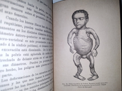 60- El Raquitismo - J. Comby - Barcelona. Espasa Y A Editores, 1895