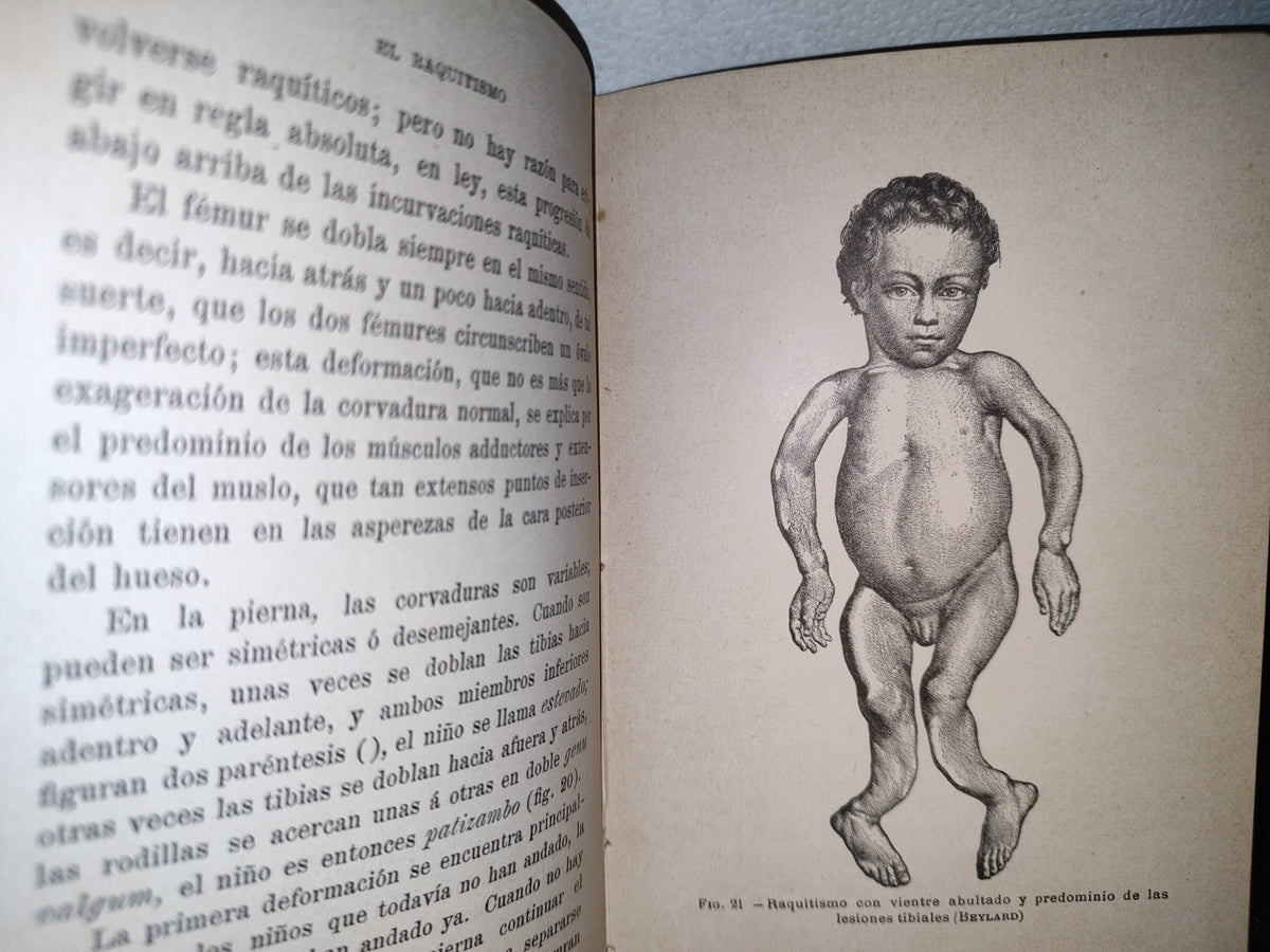 60- El Raquitismo - J. Comby - Barcelona. Espasa Y A Editores, 1895