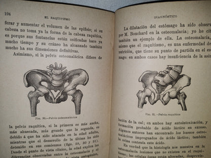 60- El Raquitismo - J. Comby - Barcelona. Espasa Y A Editores, 1895