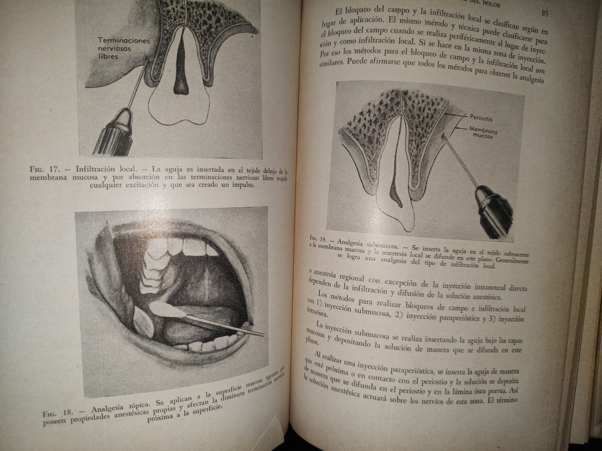 192- Anestesia Local Y Control De Dolor En La Práctica Dental - Leonardo M. Monheim - 1959