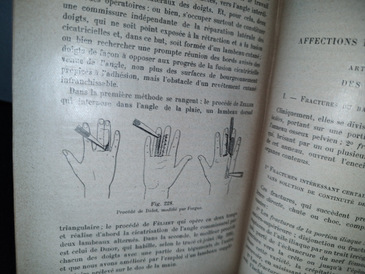 59- Francés. Compendio De Patología / Précis De Pathologie Externe - E. Forgue - 1906